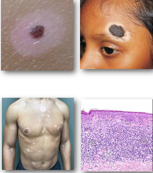 <ul><li><p>inflammatory reaction that causes depigmentation around nevus</p></li></ul><p></p>