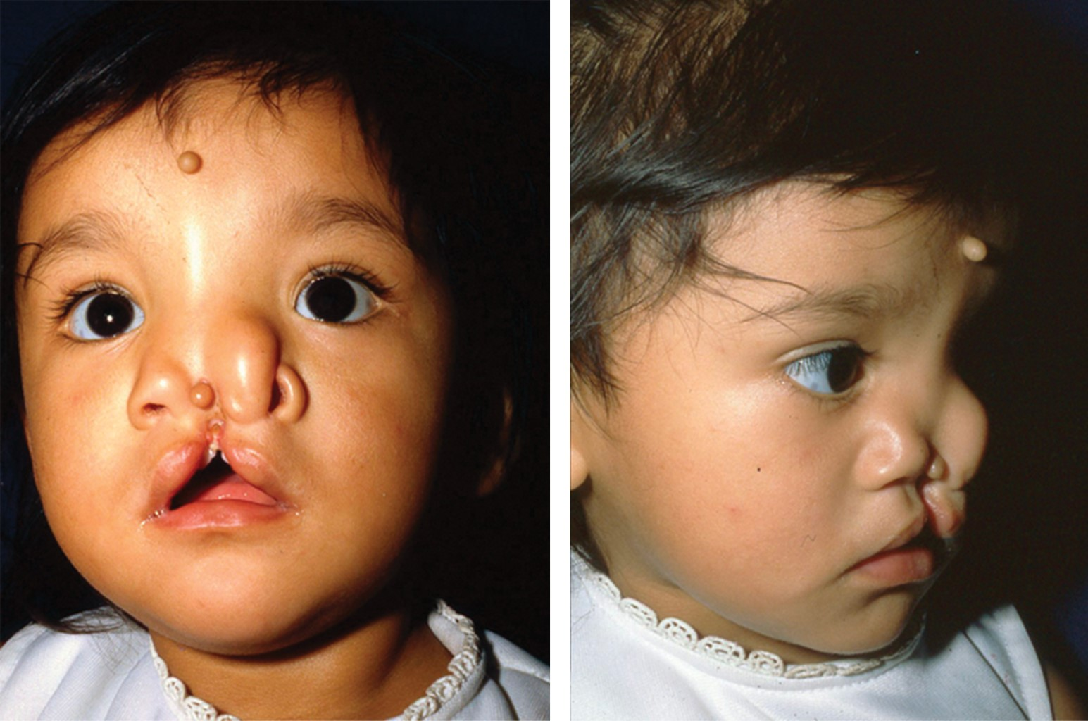 <p>desarrollo anómalo de estructuras nasales por alteraciones en crecimiento/ migración facial</p>