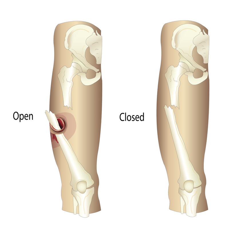 <p>Closed/Simple: No contact with outside environment</p><p>Compound/Open: Bone/soft tissue contact with outside environment</p>