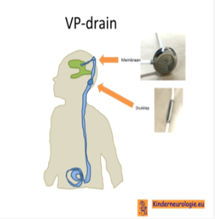 <p>-Afwachtende houding (zeker bij lage graden). Lichaam kan dit eventueel resorberen.</p><p>-Lumbale punctie en medicamenteuze therapie.</p><p>-Eventueel definitieve drain/shunt op latere leeftijd (>2500g en >4 weken oud).</p>
