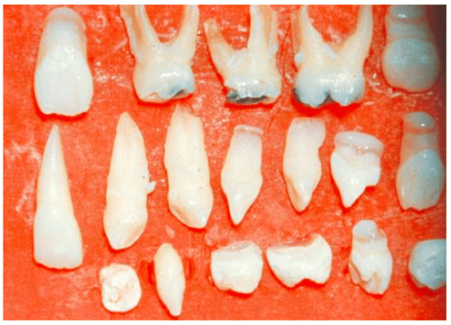 <p><br>-multiple extracted supernumerary teeth rom the patient with cleidocranial dysplasia</p><p>-results in cranium developing into a mushroom shape because the fontanelles remain open</p><p>-the premaxilla is generally underdeveloped</p>