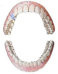 <p>maxillary right first bicuspid</p>