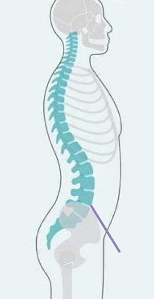 <ul><li><p>anterior tilt of the pelvis</p></li></ul><p></p>