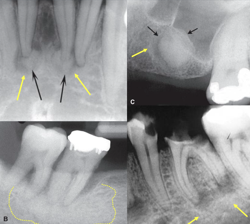 <p>thick radiopaque border of reactive bone</p><p>indicates slow growth, potential of the lesion to stimulate production of bone</p>