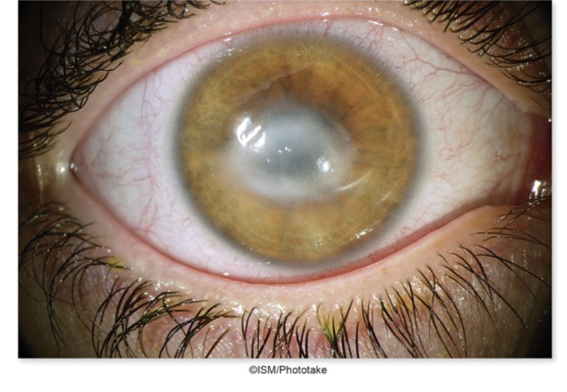 <p>Keratitis</p>