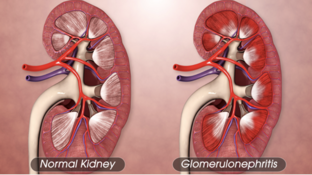 <p>What<strong> </strong>is<strong> Glomerulonephritis</strong>?<strong> </strong></p>