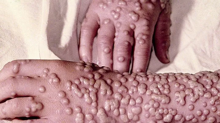 <p>Smallpox</p>