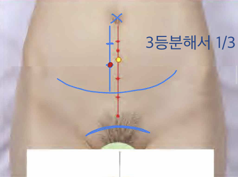 <p>앞정중선 위, 배꼽 중심 아래 2寸</p>