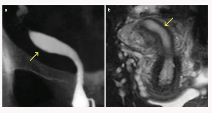 <p>Name the uterine anomaly </p>