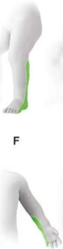 <p>this limb deficiency would be considered ___________</p>