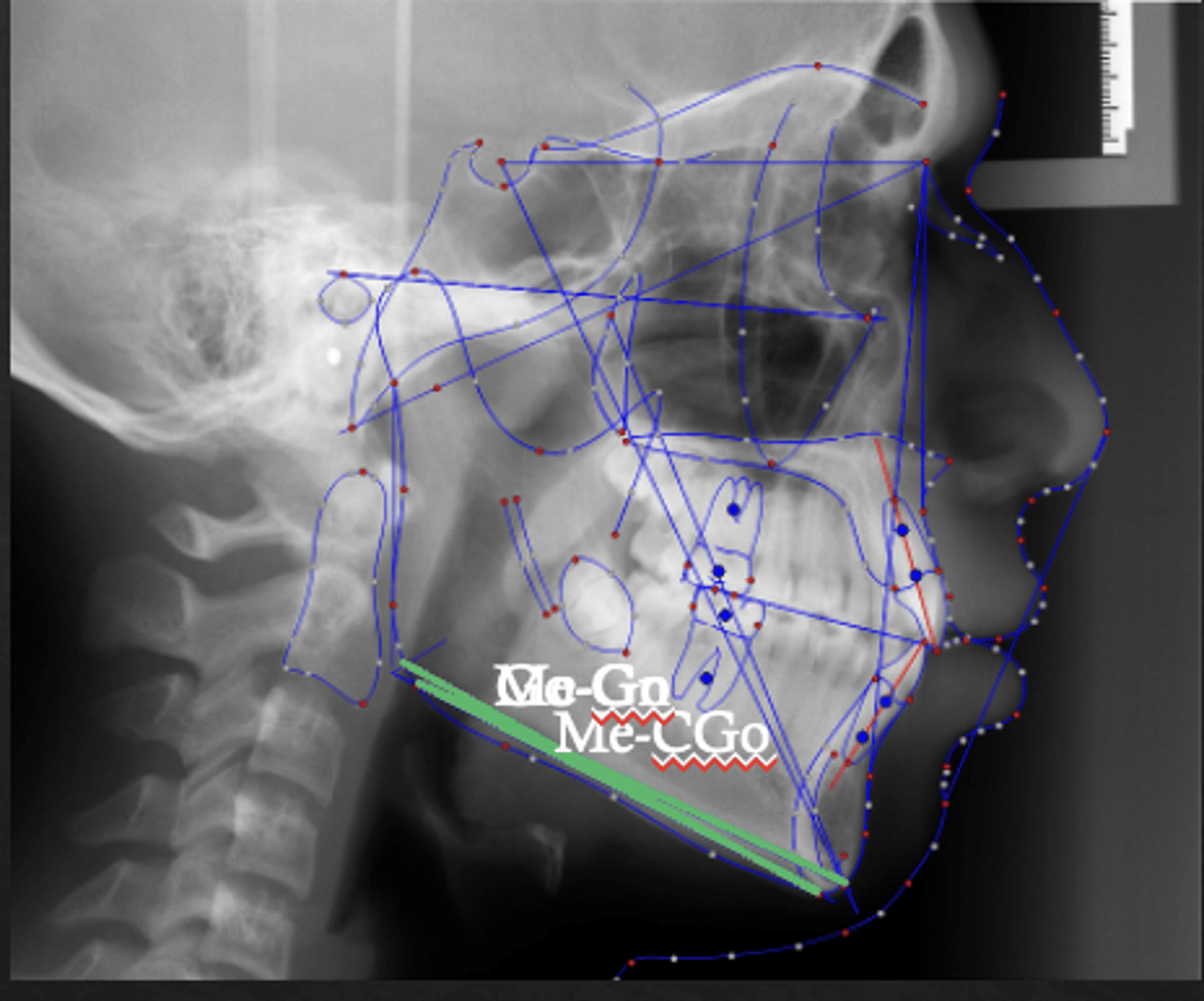 <p>which reference plane:</p><p>- Tangent line to lower border of the mandible</p><p>Three definitions:</p><p>- Me-Go</p><p>- Me-Constructed Go (This is what the American Board of Orthodontics uses)</p><p>- Go-Gn</p>