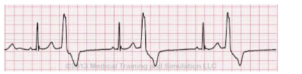 <p></p><p>Identify the above waveform:</p><p>a. unifocal PVCs</p><p>b. Trigeminy</p><p>c. First degree heart block</p><p>d. multifocal PVCs</p>