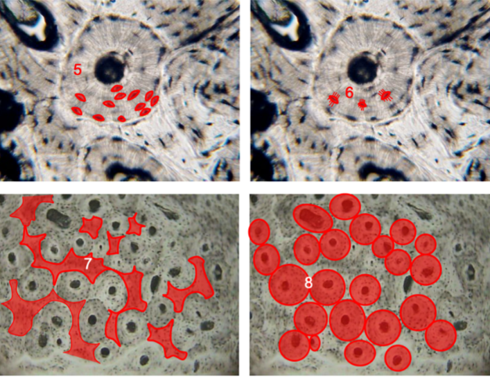 <ol start="5"><li><p>lacuna</p></li><li><p>osteocytes</p></li><li><p>interstitial lamellae</p></li><li><p>multiple osteons</p></li></ol><p></p>