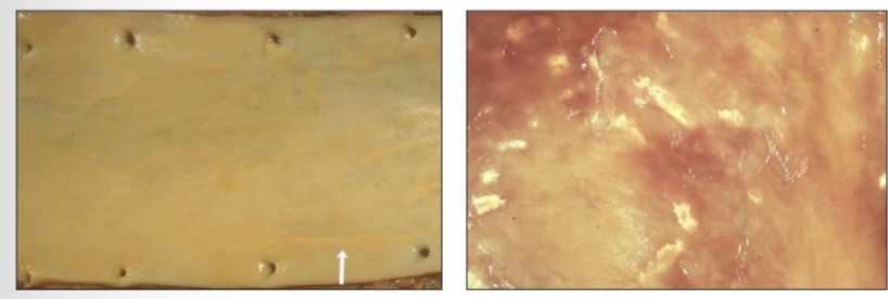 <p>Estrías grasa </p><p>Macrofagos espumosos</p>