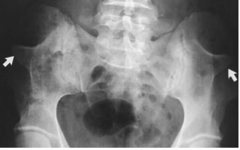 <p>post-natal radiographic finding of bone protrusions from the iliac crest of the hips. Asymptomatic but essentially pathognomic of Nail-Patella Syndrome.</p>