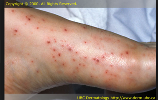 <p>Causative Agent: Gram-negative diplococci (meningococcus), most commonly strains A, B, C, and Y<br>Symptoms/Signs: Acquired through droplets or secretions; Sudden onset of High fever, sore throat, widespread bleeding under the skin, shock, coma, generalized intravascular clotting, cardiac failure, adrenal gland damage, and <strong>death within a few hours</strong>.</p>