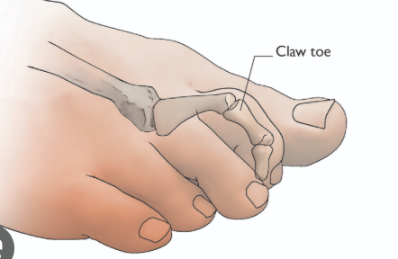 <p>-Thinning or shifting of the fat pad under the metatarsal heads decreases cushioning and increases areas of pressure. </p><p>-In claw toe deformity, toes are hyperextended and increase pressure on the metatarsal heads (ball of the foot). </p><p>-These changes predispose the patient to callus formation, ulceration, and infection</p>