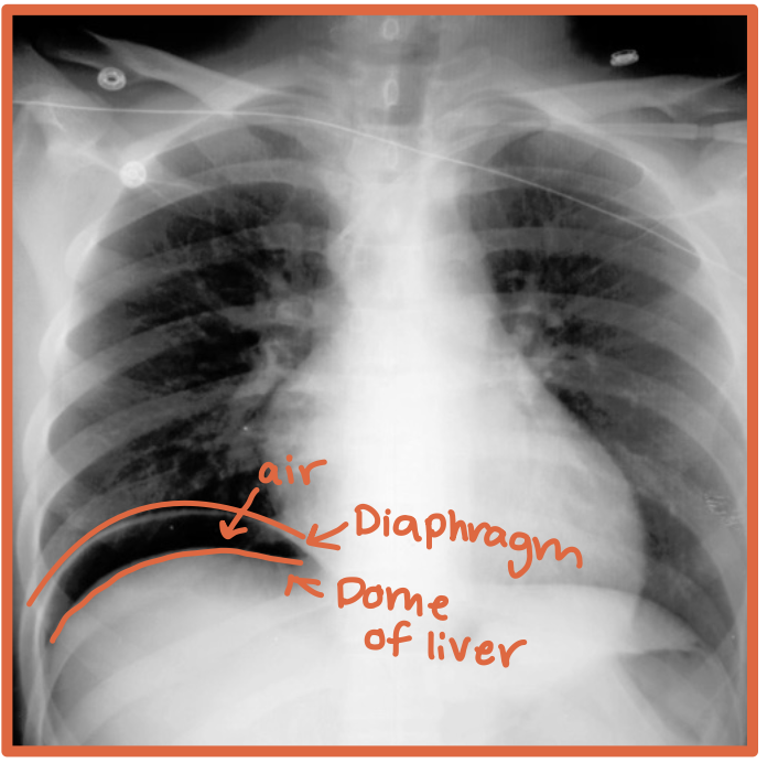 <p>Gastric or bowel gas inside the GI tract</p>