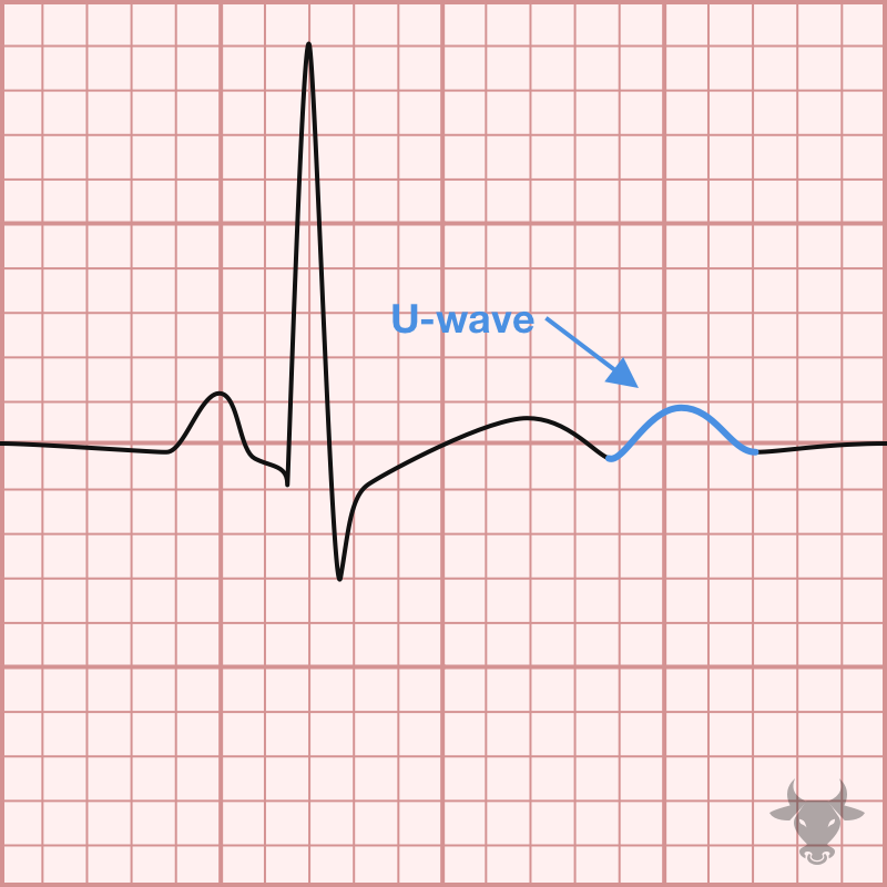 <p>Identify the electrolyte imbalance based on the ECG: </p><ul><li><p>Flat/inverted T wave</p></li><li><p>ST depression</p></li><li><p>U wave</p></li></ul><p></p>