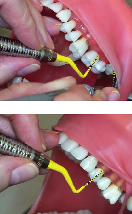 <ul><li><p>3 o’ clock position</p></li><li><p>Chin up</p></li></ul><p></p><p><strong>Mirror use (Retraction)</strong></p><ul><li><p>Retract the buccal mucosa w/ the mirror</p></li><li><p>Use mirror for indirect vision to view distal surfaces</p><ul><li><p><span>Use extraoral finger rest w/ dental mirror </span></p></li></ul></li></ul><p></p><ol><li><p><strong>Second molar, facial aspect</strong></p></li></ol><ul><li><p>Finger rest on the occlusal surface</p></li></ul><p></p><ol start="2"><li><p><strong>First premolar, facial aspect</strong></p></li></ol><ul><li><p>Finger rest on incisal surface of one of maxillary anterior teeth</p></li></ul><p></p>