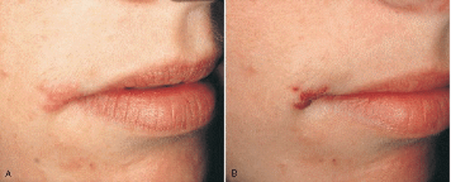 <p>blister-like sores on the lips and adjacent facial tissue that are caused by the oral herpes simplex virus type 1 (HSV-1); also known as cold sores or fever blisters</p><p><span>The cluster of vesicles seen at this pt's vermillion border is commonly called a fever blister or cold sore. What is your DHDx?</span></p>