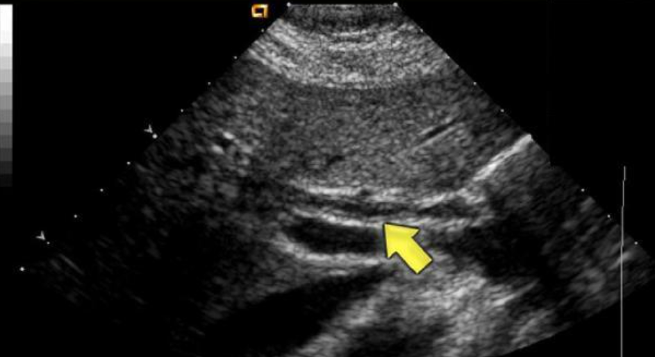 <p>A patient presents with a low grade fever, leukocytosis, nausea, diarrhea, and LLQ pain. What is the most likely explanation for the findings on the image? </p><p>a. mass at the Ampulla of Vater</p><p>b. Caroli disease</p><p>c. biliary stricture in the cystic duct</p><p>d. primary sclerosing cholangitis</p>