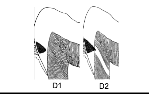 <p>D1 och D2</p><ul><li><p>emaljkaries, eller ett angrepp med spridning i emalj eller obetydlig spridning i dentin. </p></li></ul><p></p>