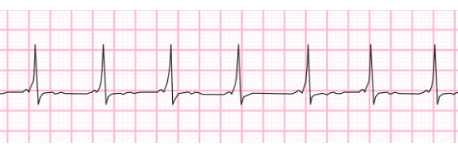 <p>what does this EKG show? </p>
