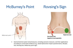 <p>-Examine for appendicitis</p><p>-Anatomical landmark located 1/3 of the way between right ASIS and umbilicus</p><p>-Positive sign = pain/tenderness present and may be increased by direct palpation</p>