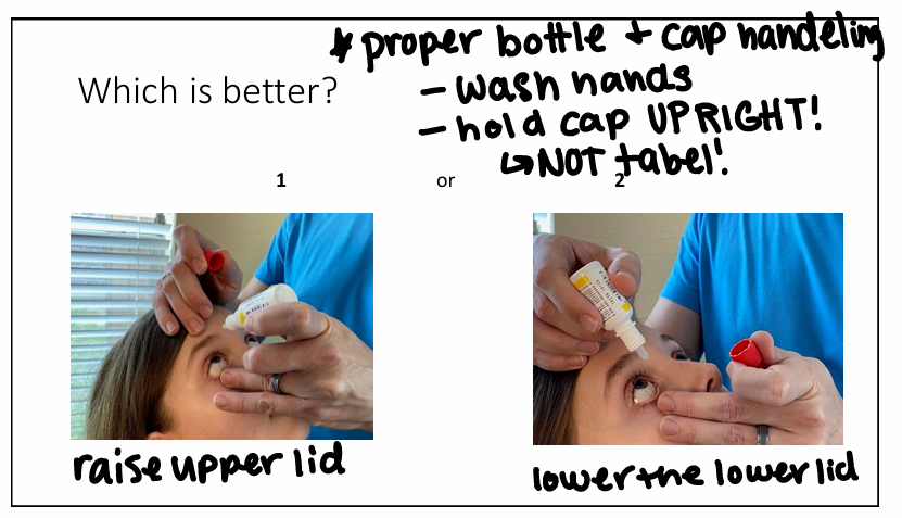 <p>The pt should look down (not up b/c they can see the drop coming &amp; will flinch - can’t control upper lid) &amp; then you can contract the upper lid. The bottle should never touch the lashes &amp; the drop should not bounce off the cornea.</p>
