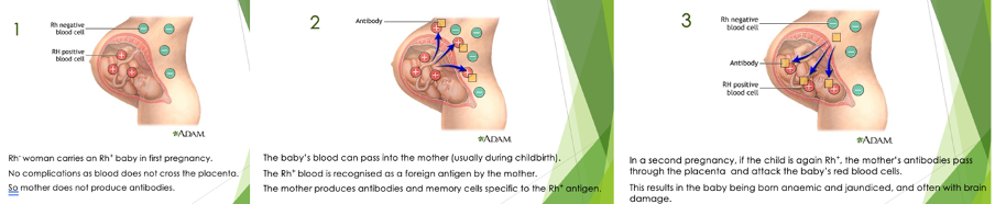 <p><span>Most people have red blood cells with antigens called the rhesus D antigen (Rh<sup>+</sup>). If no antigen is present, the person is Rh<sup>-</sup>.</span> <span>When Rh<sup>+</sup> and Rh<sup>-</sup> come into contact, antibodies will be produced against the other antigen.</span> <span>This can occur when a mother’s natural active immunity causes her immune system to attack the red blood cells of her unborn foetus. </span></p><p><span><strong>Treatment/Prevention:</strong> These days if this situation arises, Rh<sup>-</sup> mothers are injected with Rh<sup>+</sup> antibodies soon after giving birth.</span> <span>These antibodies destroy any foetal Rh antigens that she may have obtained.</span> <span>Therefore, her body does not have time to produce an adaptive immune response, and she does not make her own Rh<sup>+</sup> antibodies or memory cells.</span> <span>The next pregnancy should then be problem-free!</span></p>