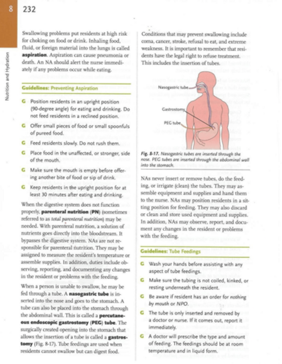 <p>Feeding tube inserted through the nose into the stomach.</p>
