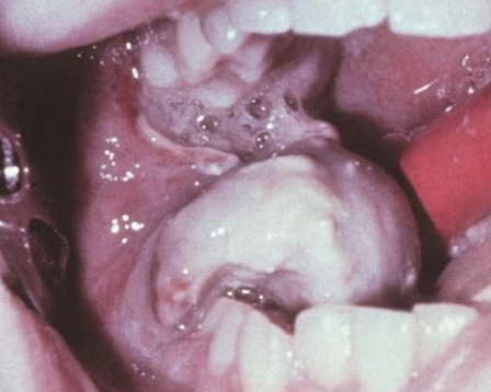 <p>jaws are only involved 2%; mand > max </p>