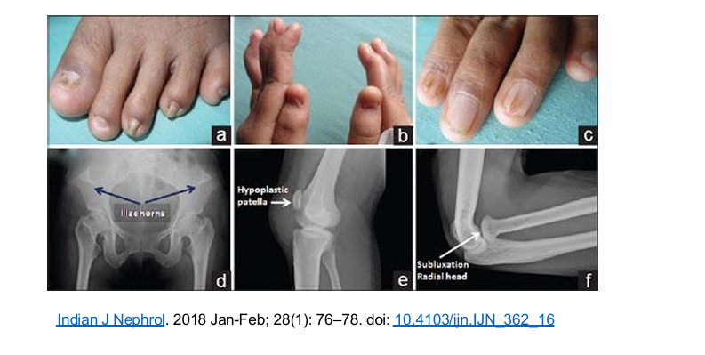 <p>What is nail-patella syndrome, NPS?</p>