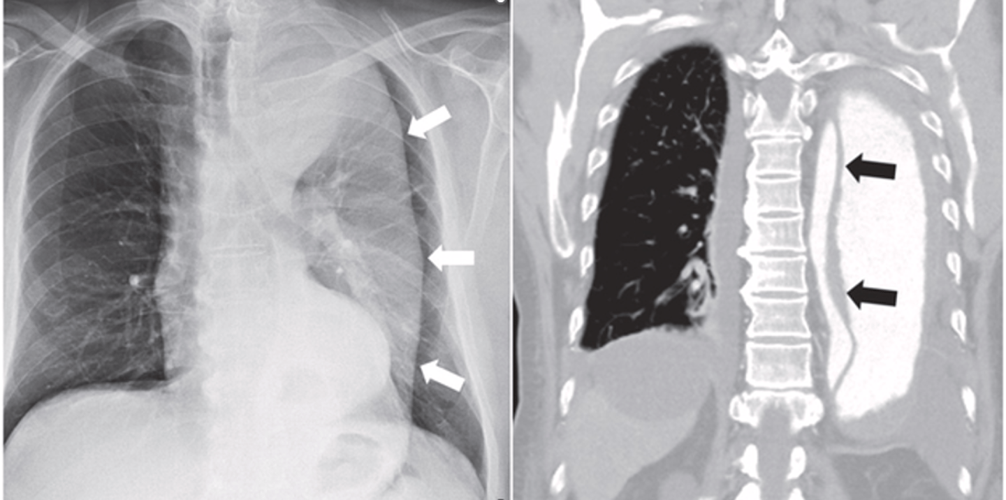 <p>D. Disection of the Aorta</p>