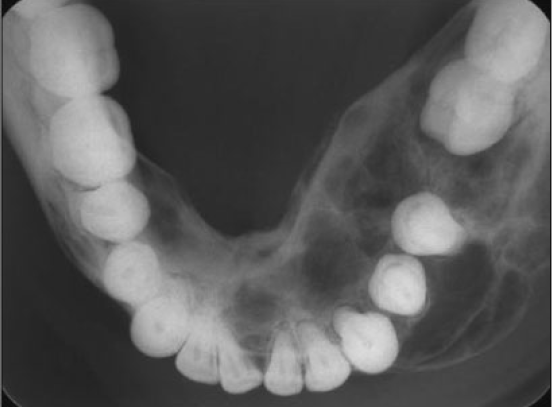 <p>central giant cell granuloma occlusal radiograph of mandible </p>