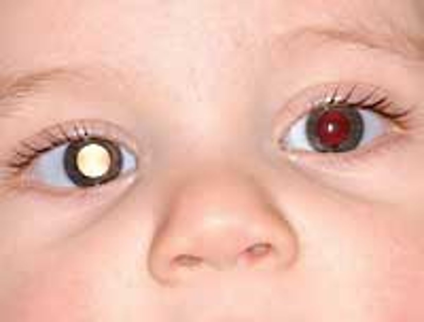 <p>shape and constriction reflex to light,</p><p>Leukocoria, a white pupil may be retinoblastoma</p>