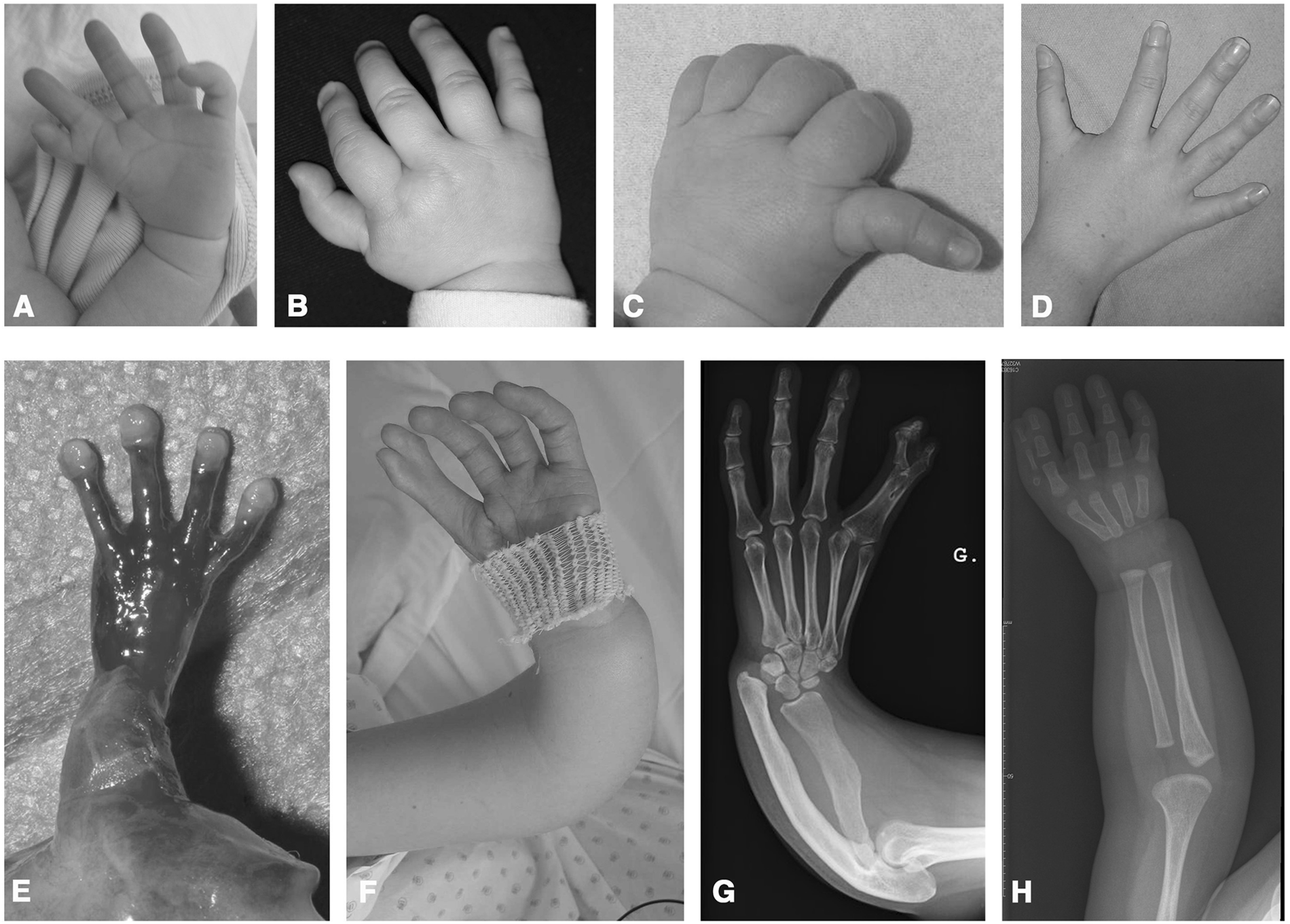 <ul><li><p>congenital heart defect </p><ul><li><p>atrial septal defect is most common</p></li></ul></li><li><p>cardiac arrhythmias</p></li><li><p>limb anomalies</p><ul><li><p>asymmetrical, absent thumb or bifid thumb, radius/ulna abnormalities</p></li></ul></li><li><p>may have other skeletal abnormalities</p></li></ul><p></p>