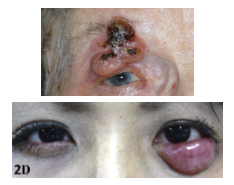 <p>What is the most likely diagnosis ?</p>