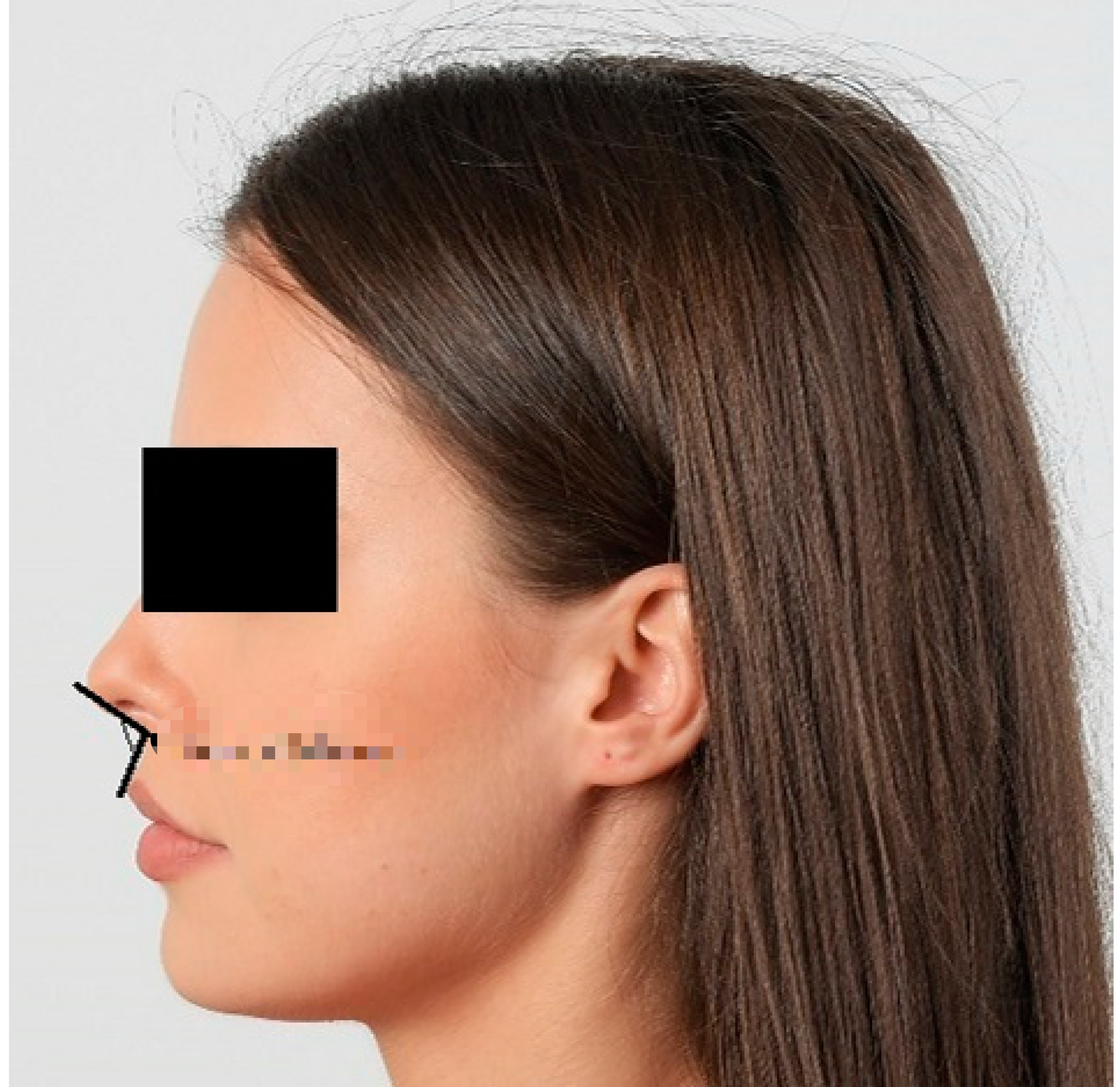 <p>the following picture is what extraoral landmark?</p>