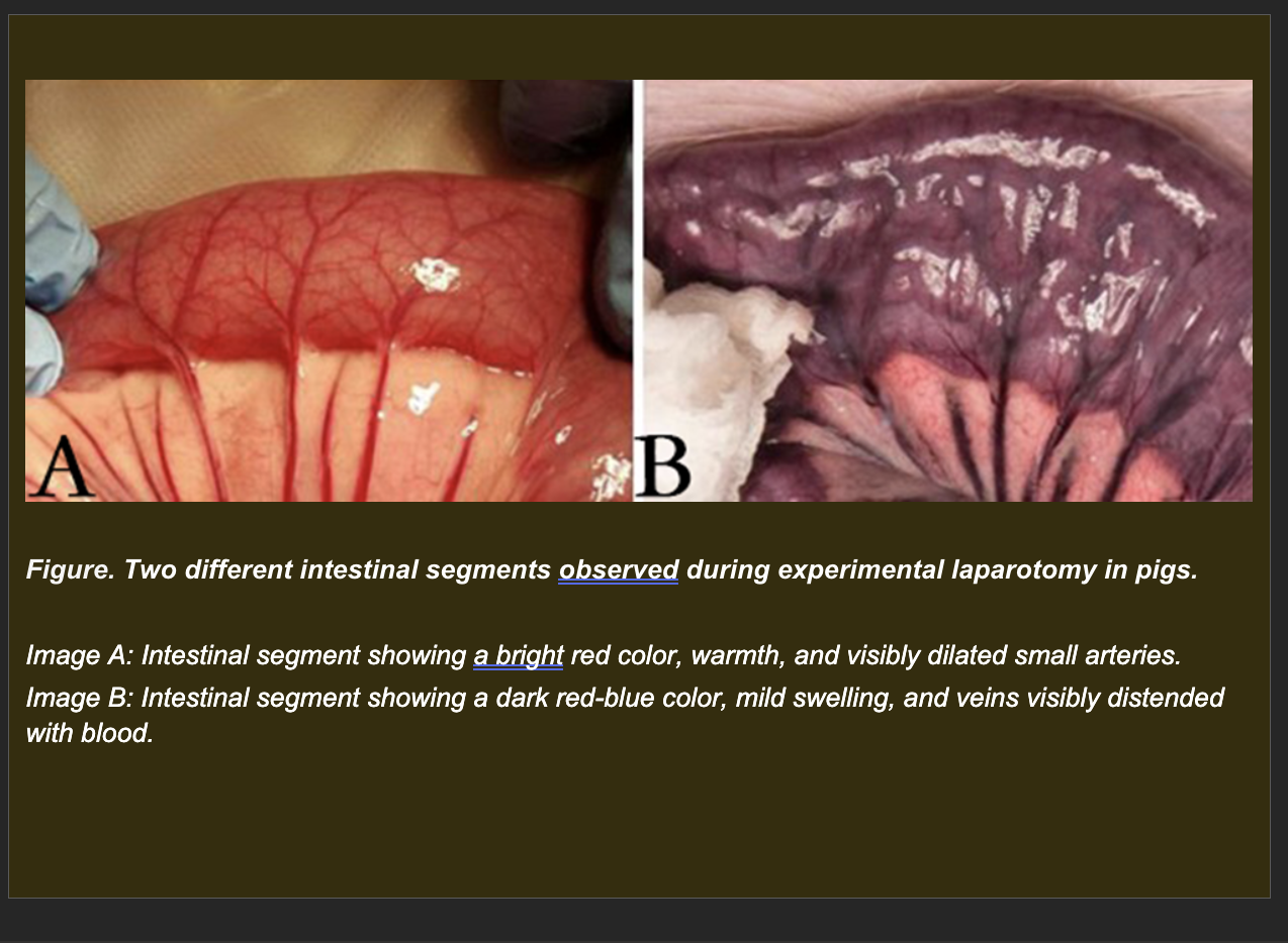 <p>Session 4A</p><p>During an experimental laparotomy in pigs, two adjacent intestinal segments are observed simultaneously.</p><p>Segment A: Bright red, warm. Small arteries supplying this segment are visibly dilated.</p><p>Segment B: Dark red-blue. Slightly swollen. Veins draining this segment are visibly distended with blood.</p><p></p><p><strong>Which interpretation best explains the difference between Segment A and Segment B?</strong></p><p><span>a. Segment A shows active hyperemia from arteriolar dilation increasing oxygenated blood inflow; Segment B shows passive congestion from impaired venous outflow accumulating deoxygenated blood</span></p><p><span>b. Segment A shows passive congestion from venous obstruction; Segment B shows active hyperemia from arterial dilation</span></p><p><span>c. Both segments show hyperemia -- the color difference reflects metabolic rate differences between the two intestinal regions</span></p><p><span>d. Segment A shows ischemia from reduced perfusion; Segment B shows hyperemia from increased venous flow</span></p>