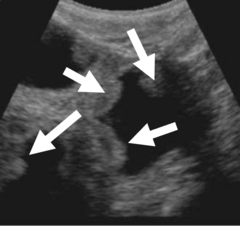<p>How are placentomes used for aging on ultrasound?</p>