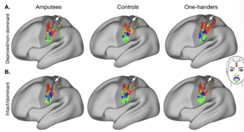 <ul><li><p><span>neuroplasticity&nbsp;after limb amputation</span></p></li><li><p><span>prediction that amputation might lead to neighbouring regions in somatotopic maps taking over the previously occupied&nbsp;territory</span></p></li><li><p><span>examined patients that has amputations</span></p></li><li><p><span>no longer receiving input would change the&nbsp;cortical representation</span></p></li></ul><p></p>