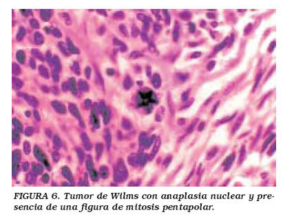 <p><strong><mark data-color="red" style="background-color: red; color: inherit;">Pleomorfismo celular y nuclear</mark></strong></p>
