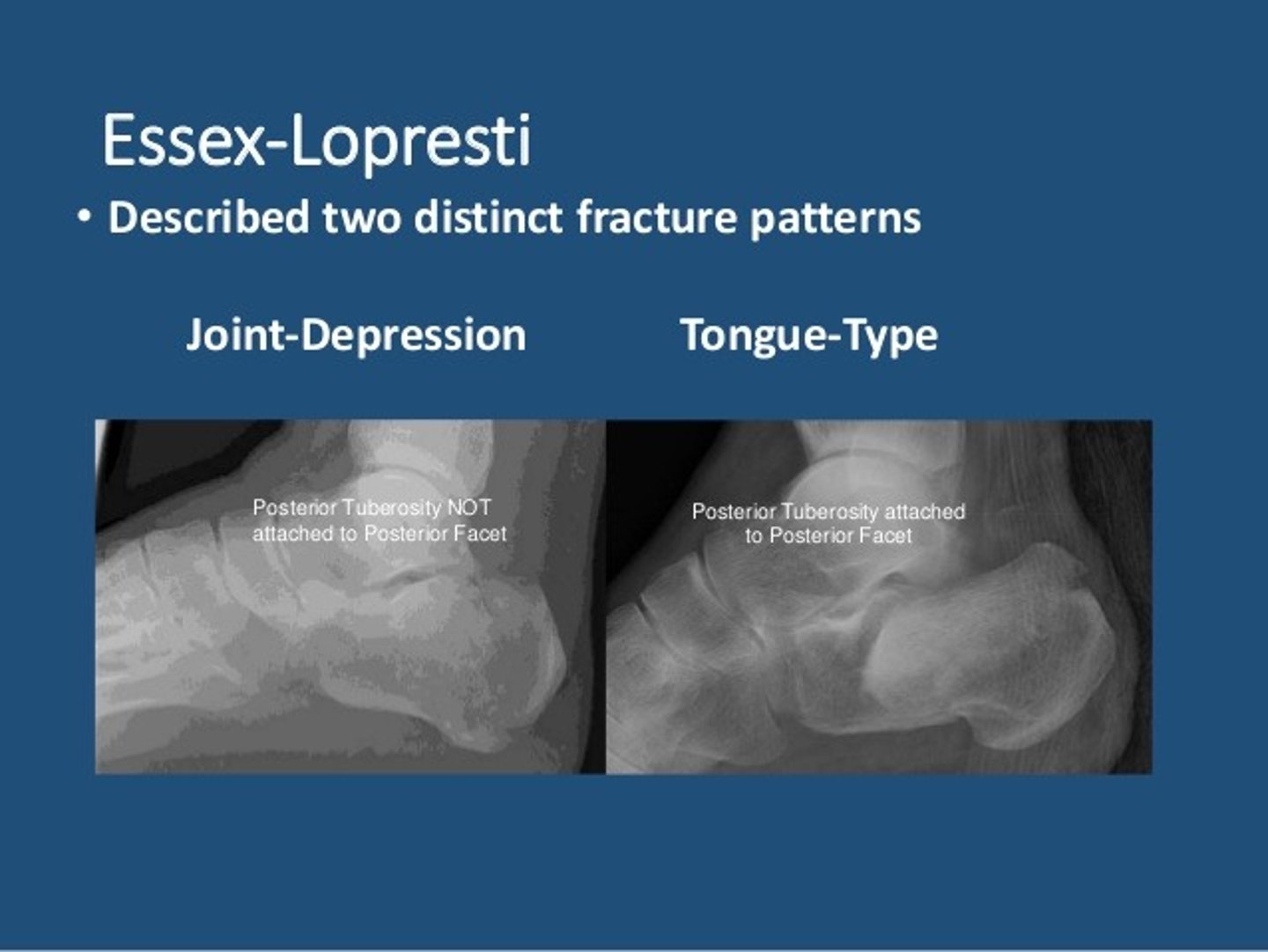 <p>ESSEX-LOPRESTI - Calcaneal fx</p><p>Type 1 - tongue fracture (vertical fracture line) without STJ involvement</p><p>Type 2 - joint depression fracture (horizontal fracture line) with STJ involvement</p>