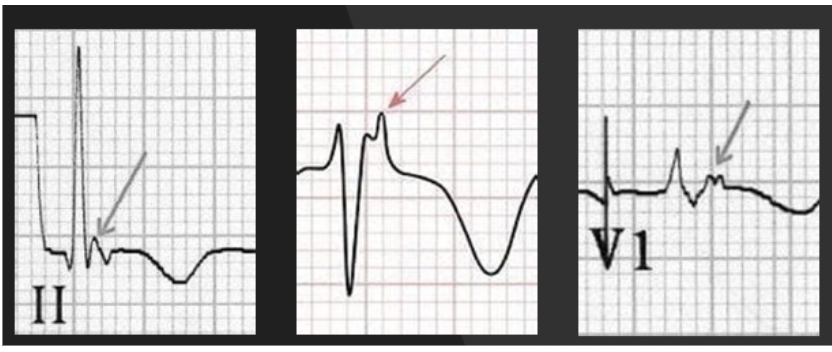 <p><strong>Epsilon Wave </strong>(fat deposition in myocardium → conduction delay)</p><ul><li><p>small deflection “blip” at the at the end of QRS complex, just before T wave</p></li></ul><p>T wave inversion and prolonged QRS in V1-V3 (right side of heart)</p>