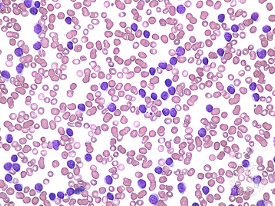 <p>This smear shows abnormally elevated lymphocytes:</p>