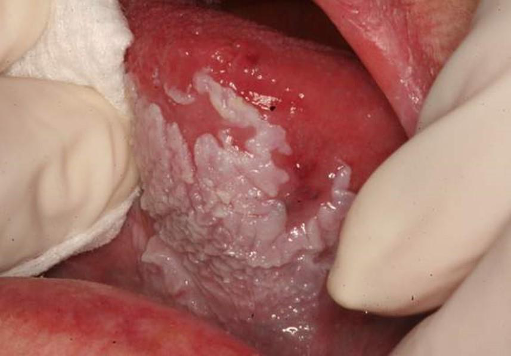 <p>CASE: A patient with established PVL develops a new keratotic plaque while older plaques are changing in surface texture. What is the appropriate long-term strategy?</p>