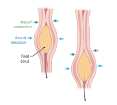 <p>Abnormal gastrointestinal motility: Increased or slowed contractions of the intestinal muscles leading to diarrhea or constipation.</p><p>Visceral hypersensitivity: Heightened sensitivity to pain or discomfort from normal gut activity.</p><p>Gut-brain interaction: dysfunction in the communication between the CNS and the gut</p><p>Stress: emotional stress, anxiety, and depression are strongly linked to IBS and worsens symptoms.</p><p>Infections: history of GI or SB bacterial overgrowth may trigger IBS symptoms.</p><p>Dietary factors: high-fat foods, caffeine, alcohol, can worsen IBS symptoms.</p>
