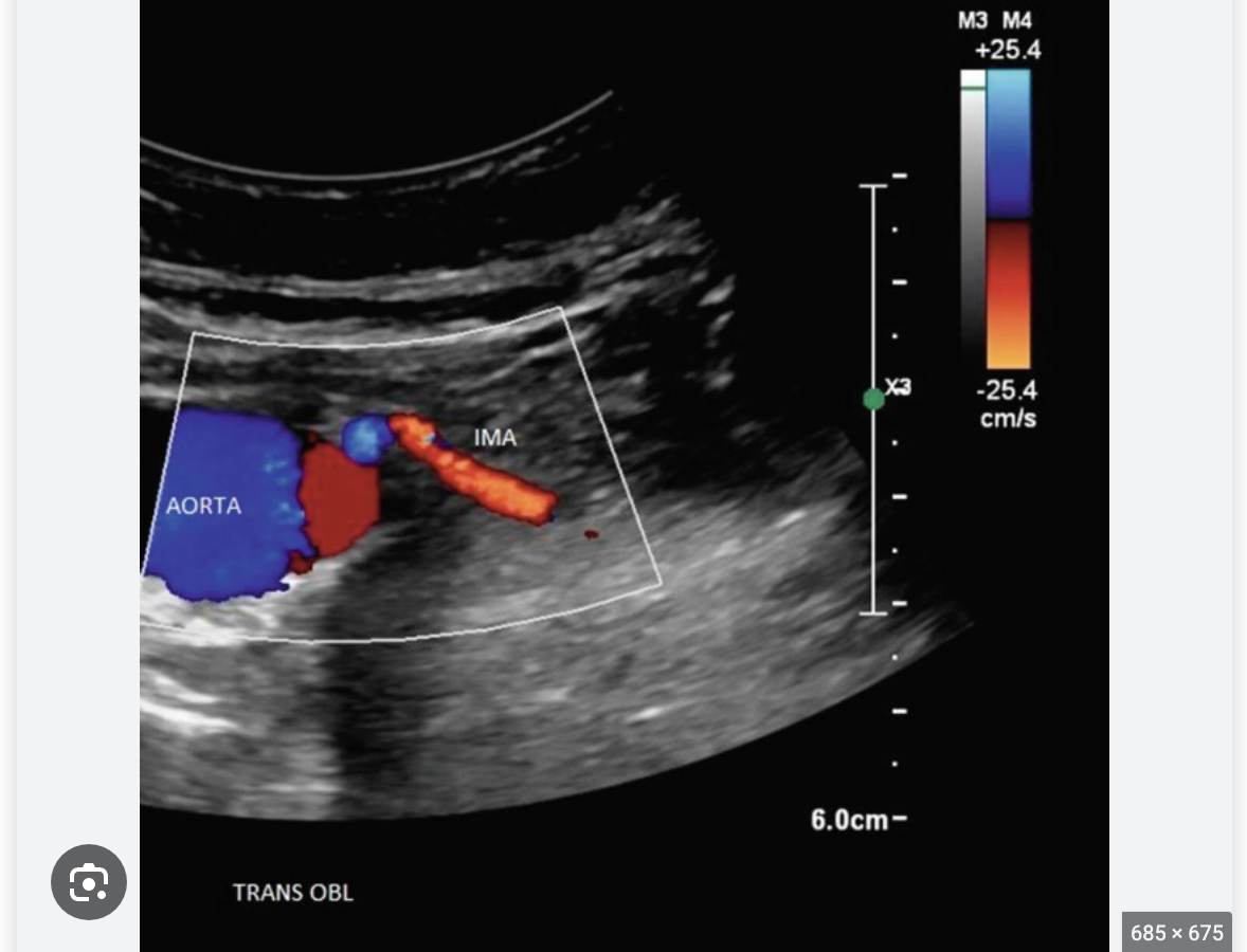 <p>what is the best technique to visualized + locate the <strong><u>inferior mesenteric artery</u></strong></p><p>.</p><p>a) sag; left of midline near umbilicus</p><p>b) coronal; left mid flank</p><p>c) sag; right of midline near umbilicus</p><p>d) trv; find renal arteries + slide inferiorly</p>
